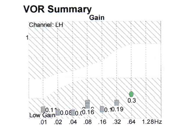 Patient H, female, 80 y.o., decrease of gain at all the frequencies