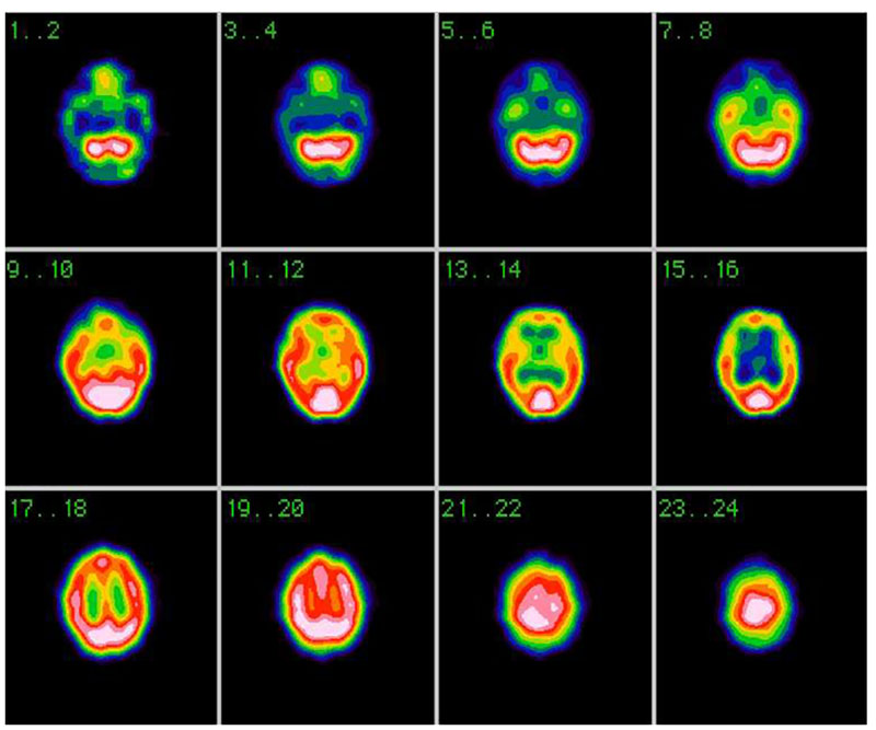 SPECT of the patient SH. with tinnitus complaints